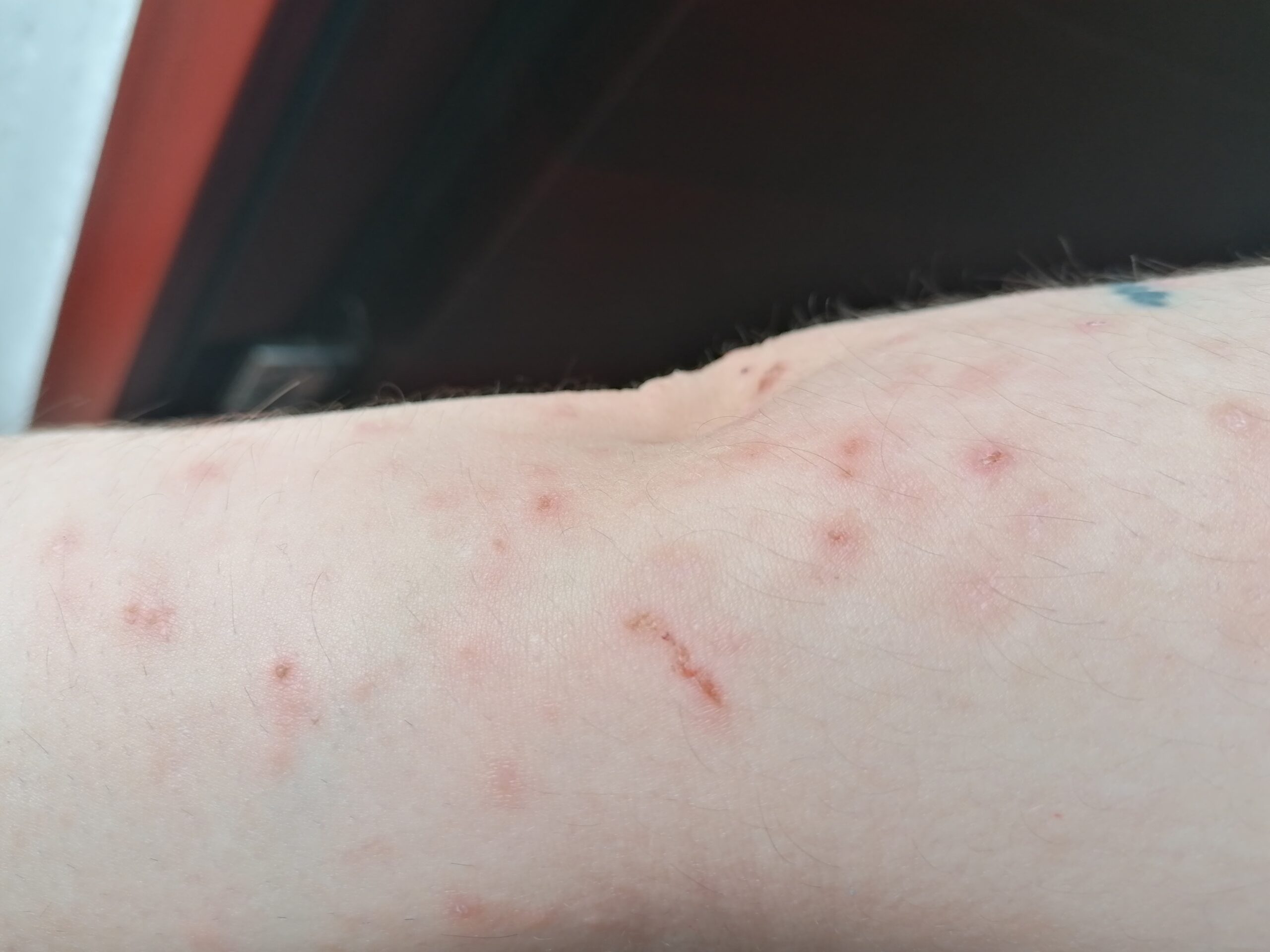 Ágyi poloska csípés